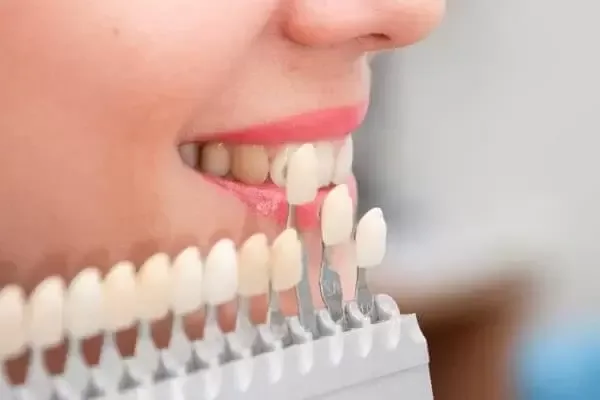 Guía de colores de carillas junto a la sonrisa de una paciente